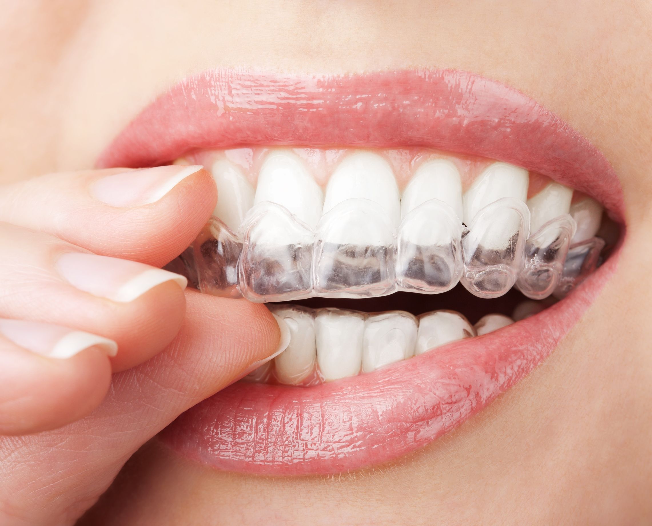 Brighten Your Smile With Teeth Whitening in Davie, Florida