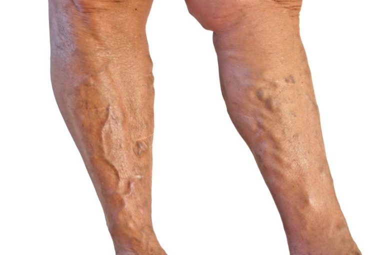 More About Varicose Veins