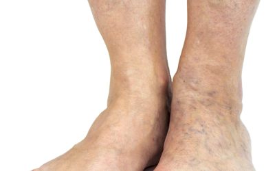 Preparing Yourself for Going Through Sclerotherapy in Schaumburg