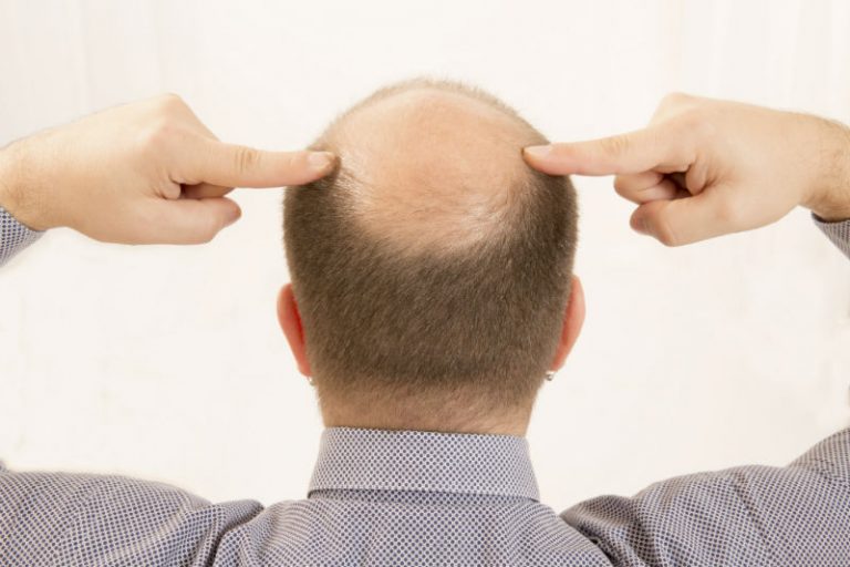 Why Getting a Washington, DC Hair Transplant Could Be a Solution for You