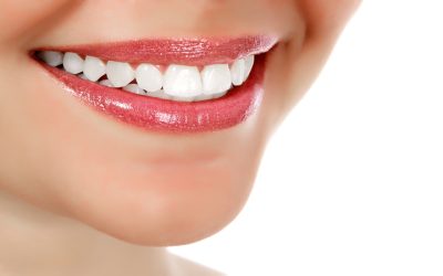 Enhancing Your Smile With Veneers in Oakwood: What You Need to Know