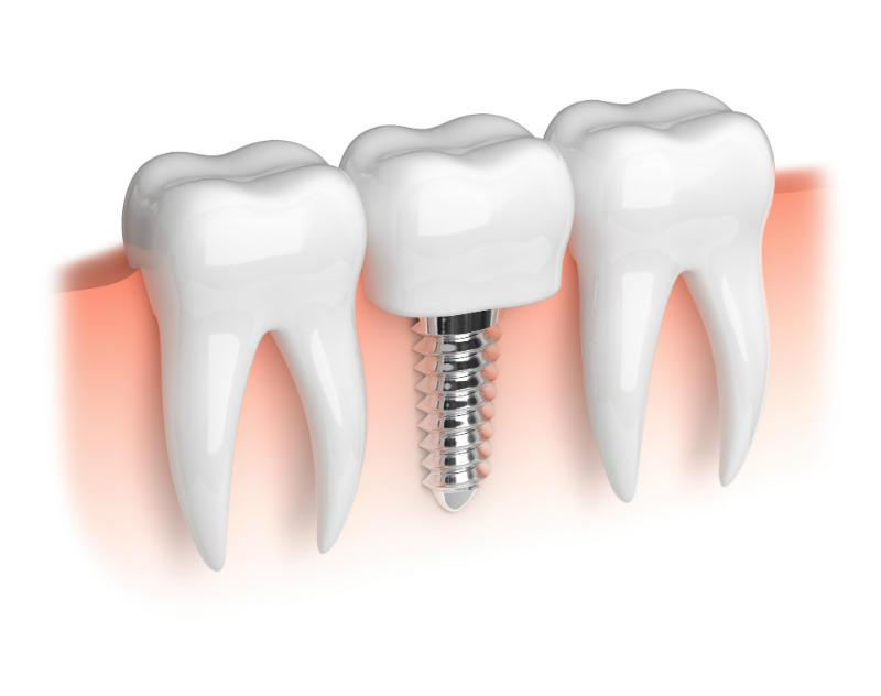 3 Reasons Why a Charleston, SC, Same Day Crown Replacement is So Great