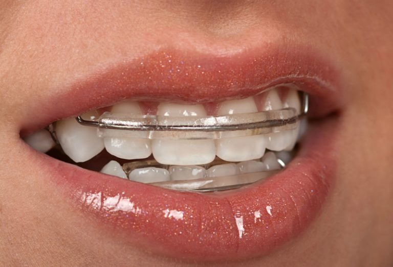 Improved, Straightened Teeth with Invisalign in Philadelphia